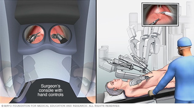 外科医生控制台和用于膀胱切除术的机器人器械
