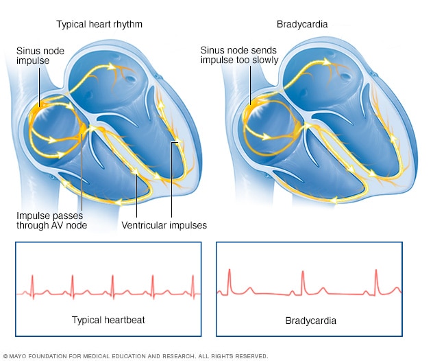 Resultado de imagen para Bradycardia