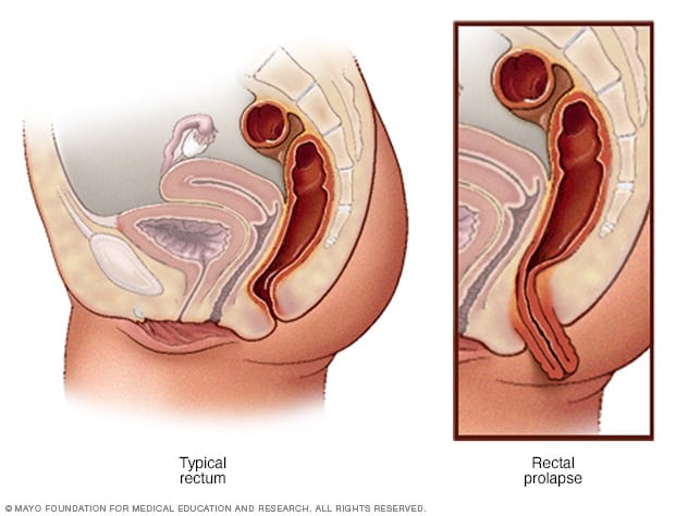 Rectal Anal 73