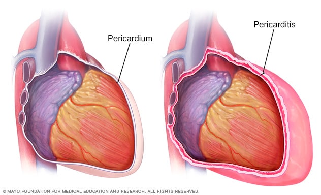 Un corazón con pericarditis y un corazón normal