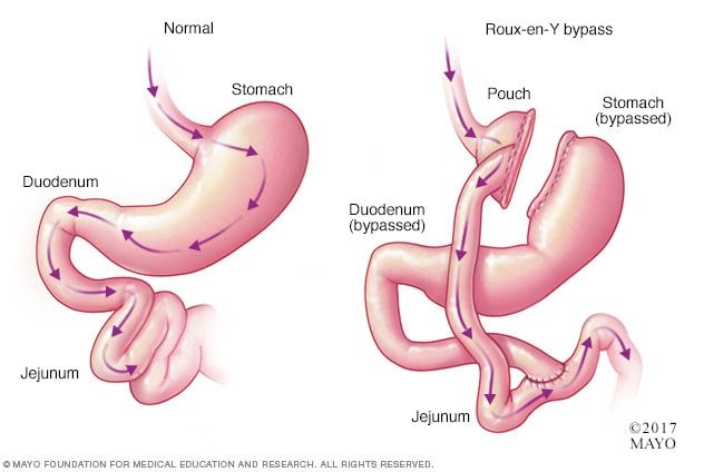 Bariatric Surgery Mayo Clinic