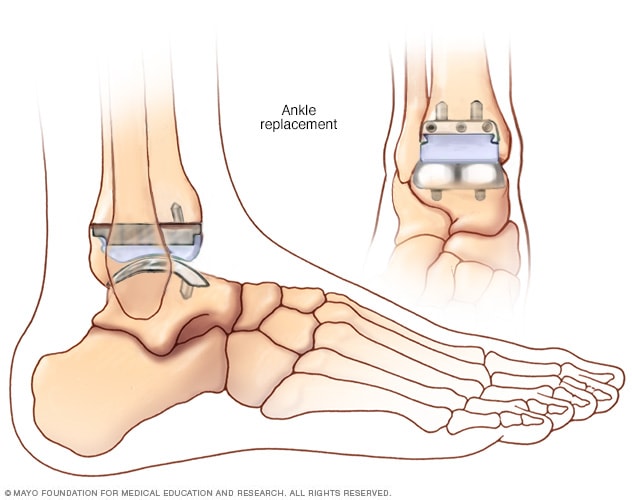 Reemplazo de tobillo