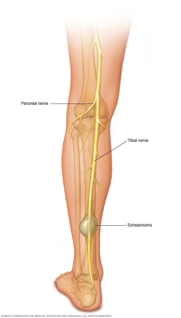 الورم الشِفاني في العصب الظنبوبي في الساق
