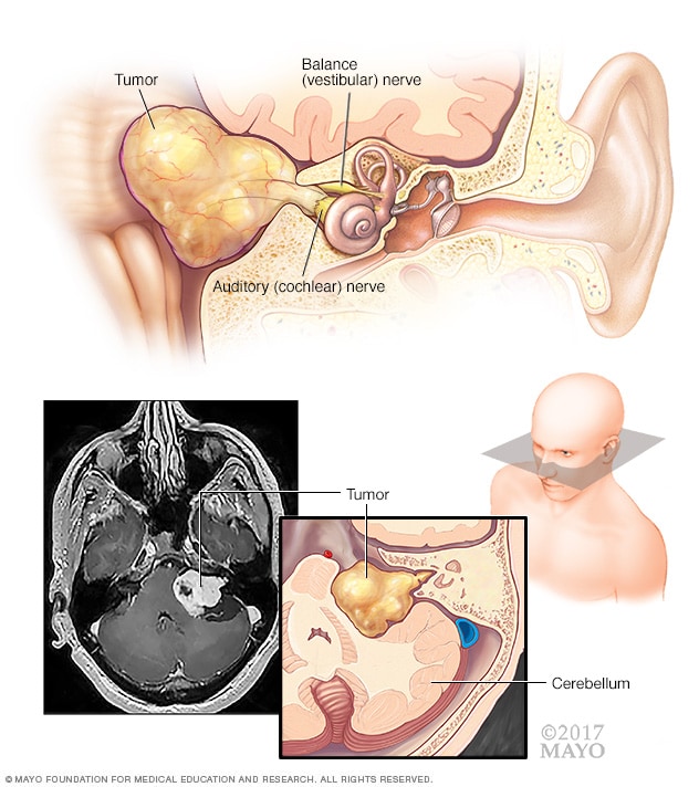 Neurinoma del acústico, un tumor benigno en los nervios que van del oído interno al cerebro.