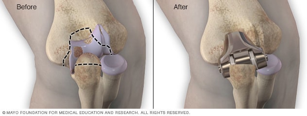 Artificial elbow joint