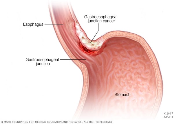 Cáncer de la unión gastroesofágica