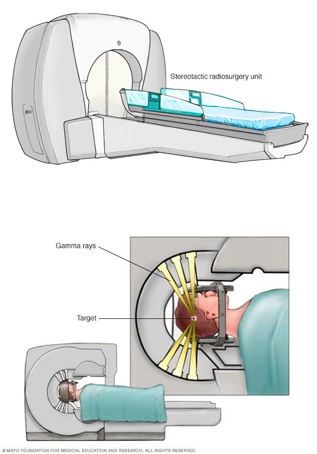 Stereotactic radiosurgery for brain metastases