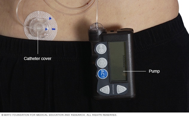 Illustration showing an insulin pump 
