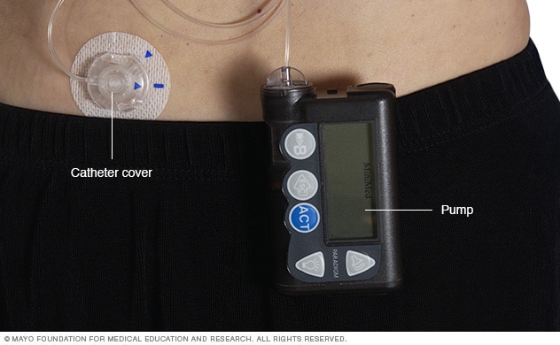 Insulin pump - Mayo Clinic