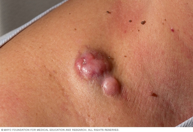 Dermatofibrosarcoma protuberante