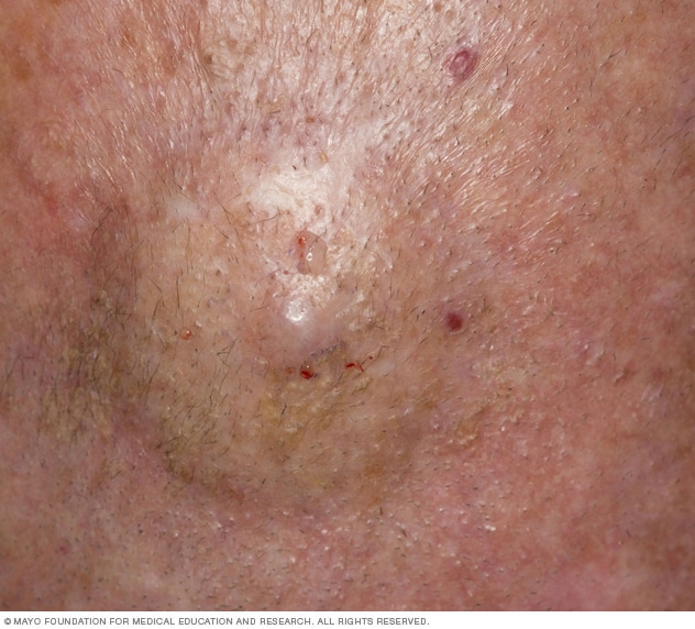 Cutaneous B Cell Lymphoma Overview Mayo Clinic