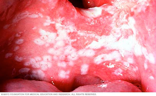 Fotografía de lesiones de candidiasis bucal en la lengua.