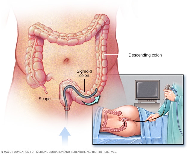 Prostatitis és mikrohematuria