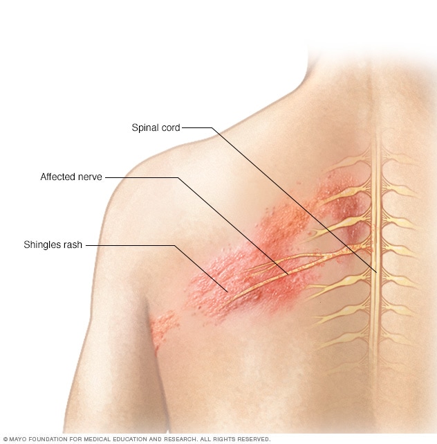 shingles on spine