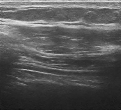 Ultrasound of patient's diaphragm