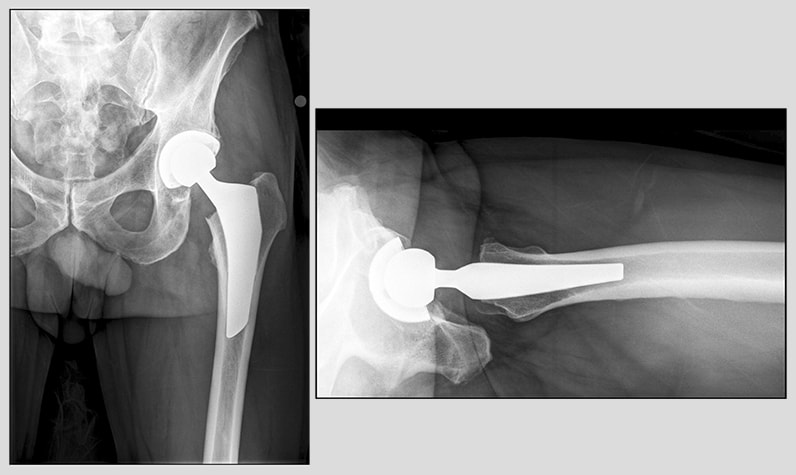 Anteroposterior and lateral radiographs of the hip