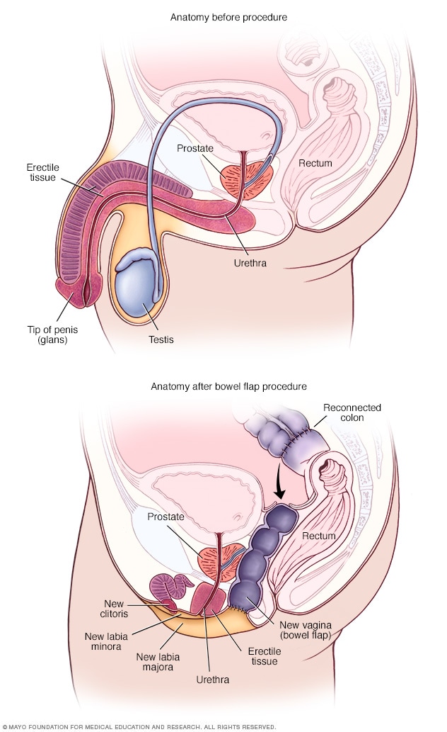 肠道皮瓣手术前后的解剖结构