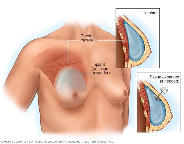 Colocación de los implantes mamarios o de los expansores tisulares