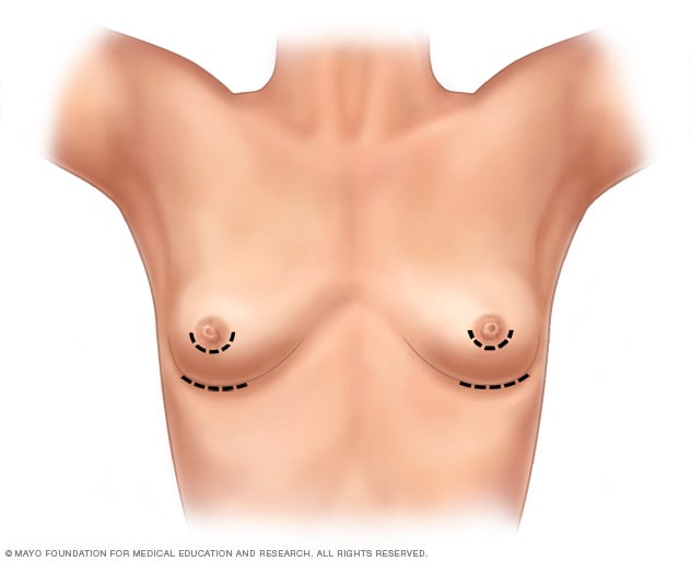 Breast augmentation - Mayo Clinic