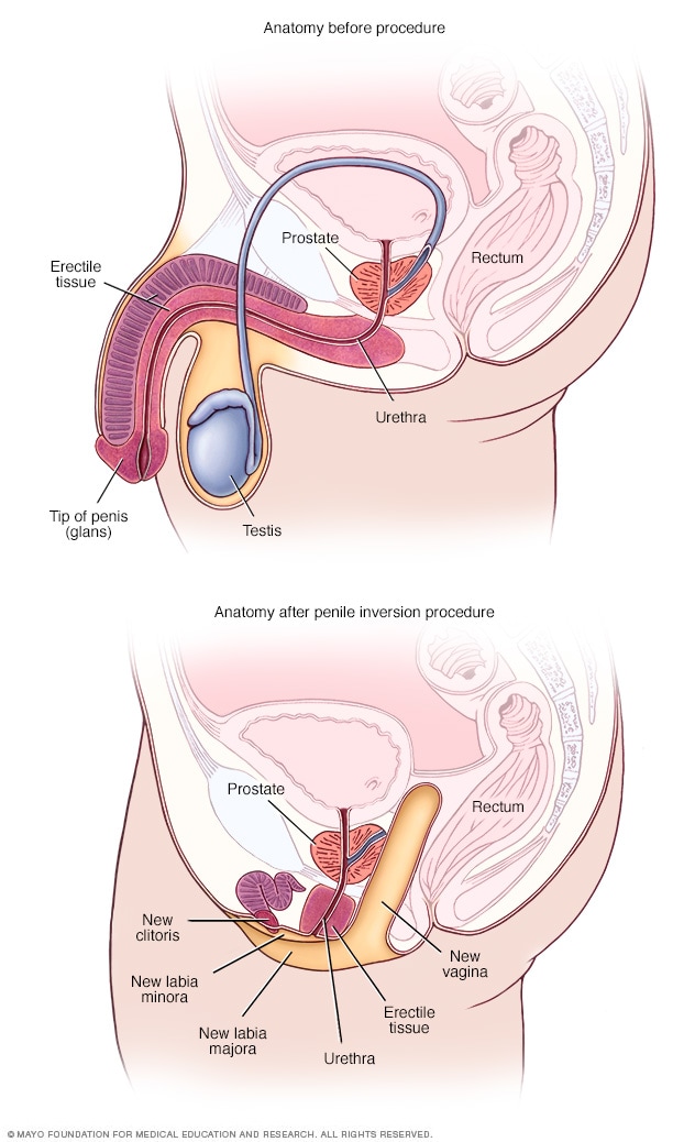 Anatomía antes y después de la inversión peniana