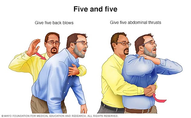 أولويَّات الإسعافات الأوَّلية في حالات الطوارئ Composite-five-and-five-heimlich-8col