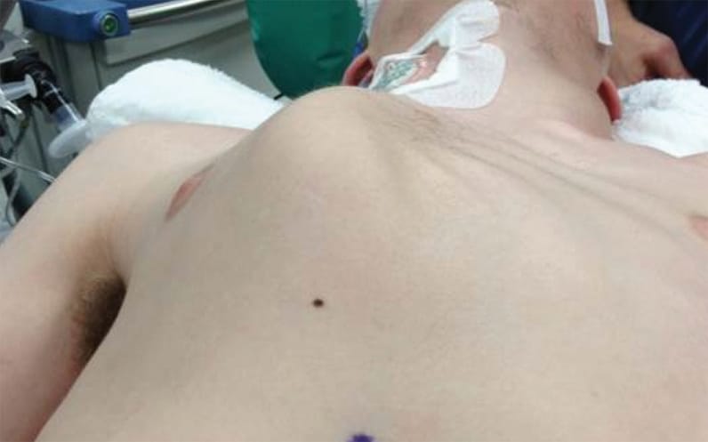 Pectus carinatum deformity