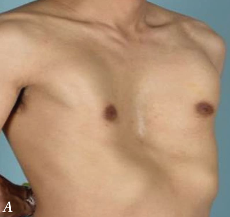  Chest wall before minimally invasive repair of pectus excavatum