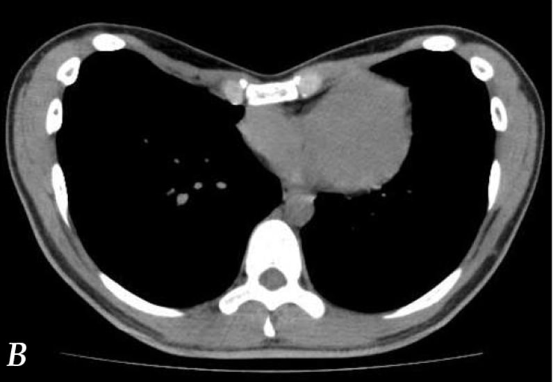 CT scan of compression of the right ventricle by the pectus excavatum
