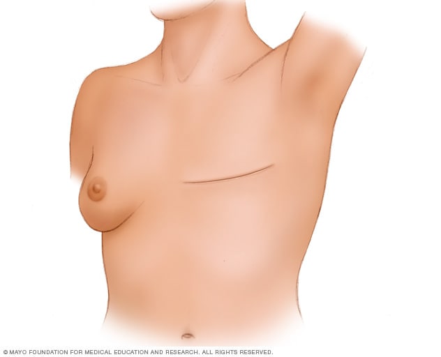 Una persona que se ha hecho una mastectomía total (simple) sin reconstrucción de la mama