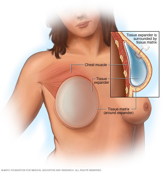 Types of breast reconstruction