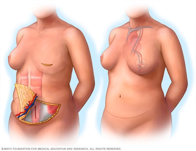 Breast reconstruction with abdominal tissue flap