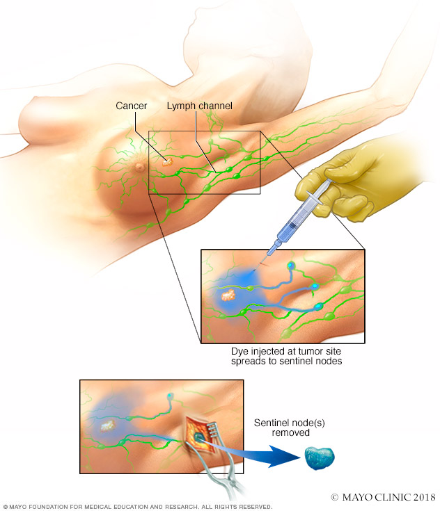 Lumpectomy - Mayo Clinic