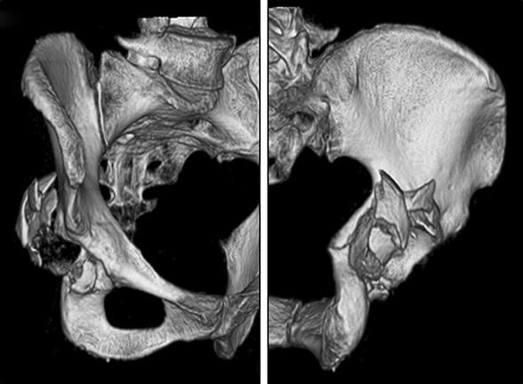Preoperative 3-D reconstruction CT scans showing acetabular injury