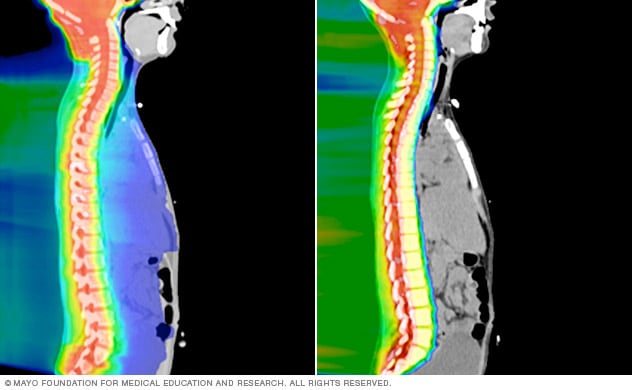 Proton beam therapy avoids unnecessary exposure to radiation compared to traditional radiation therapy.
