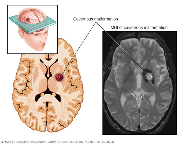 Malformaciones Cavernosas Sintomas Y Causas Mayo Clinic
