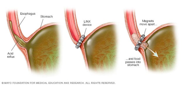 The ring of beads between the esophagus and stomach