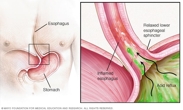 Penyakit refluks gastroesophageal