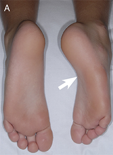Feet demonstrating atrophy and inversion of the affected foot