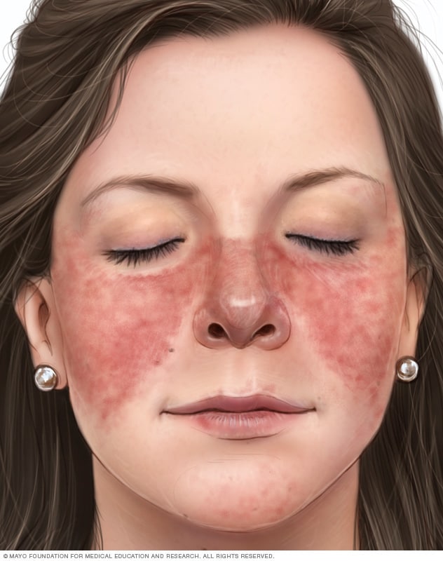 Red, butterfly-shaped rash on nose and cheeks