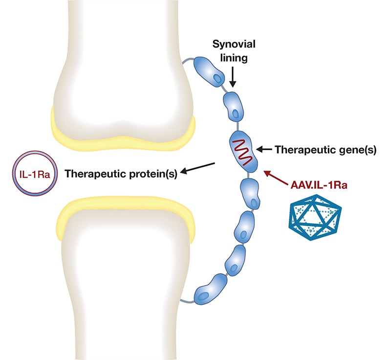 Gene therapy for knee osteoarthritis