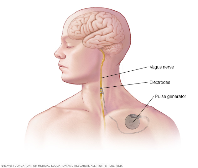 Vagus nerve stimulation - Mayo Clinic