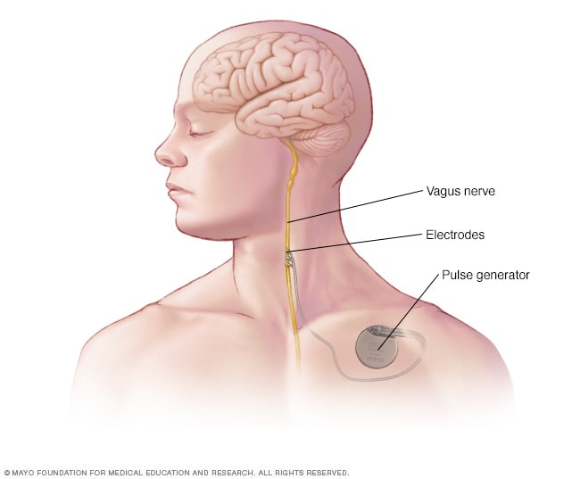Colocación del dispositivo en la estimulación del nervio vago