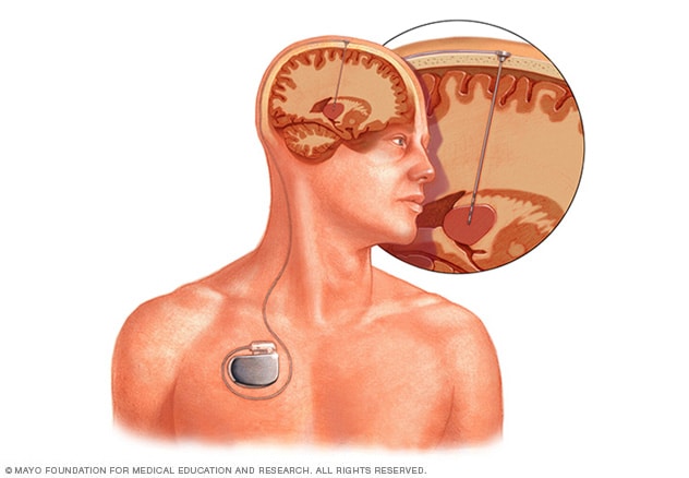 Colocación de electrodos y ubicación del dispositivo en la estimulación cerebral profunda