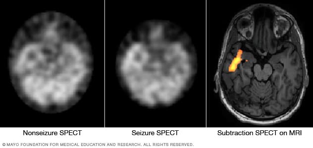 En un conjunto de imágenes cerebrales, se muestra una tomografía computarizada por emisión de fotón único no convulsiva, una tomografía computarizada por emisión de fotón único convulsiva y una tomografía computarizada por emisión de fotón único de sustracción con corregistro de una resonancia magnética.
