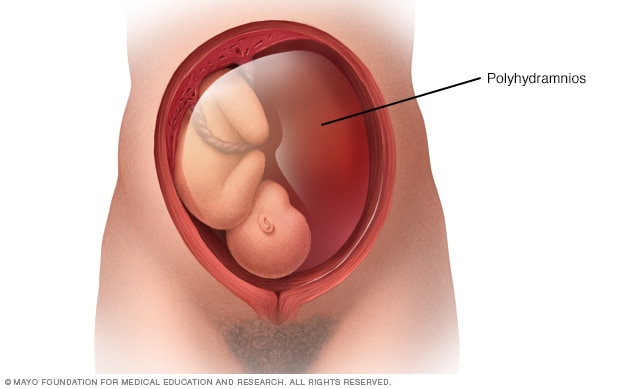 Exceso de líquido amniótico que rodea al bebé en el útero (polihidramnios)