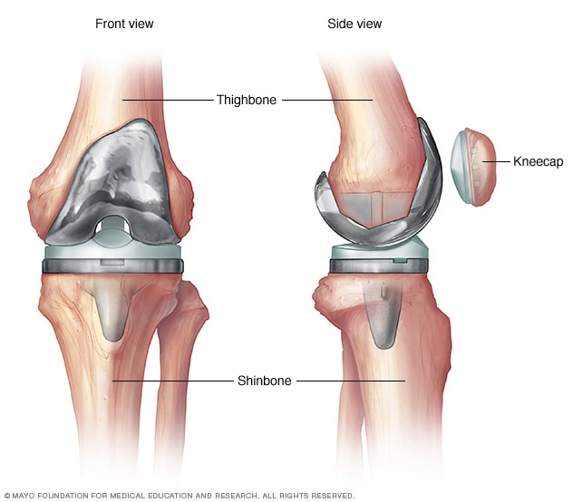 Ilustración de una rodilla artificial 
