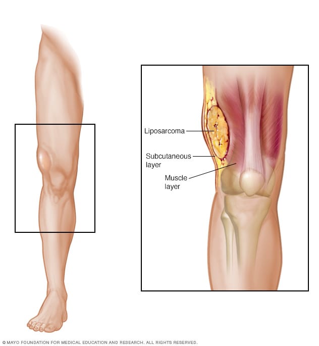 cancer sarcoma maligno)