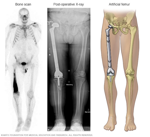 Fémur canceroso reemplazado por componentes artificiales