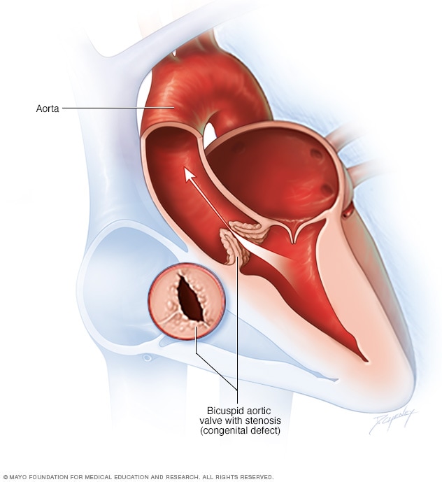 Bicuspid Aortic Valve Overview Mayo Clinic