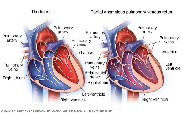 Retorno venoso pulmonar anómalo parcial